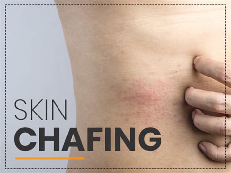 Chafing Causes Symptoms Complications Treatment Prevention Chafing Causes Symptoms Complications Treatment Prevention