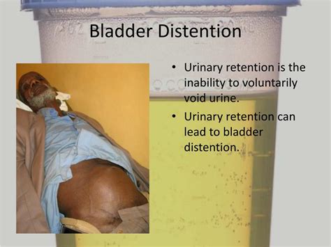 Distended Bladder