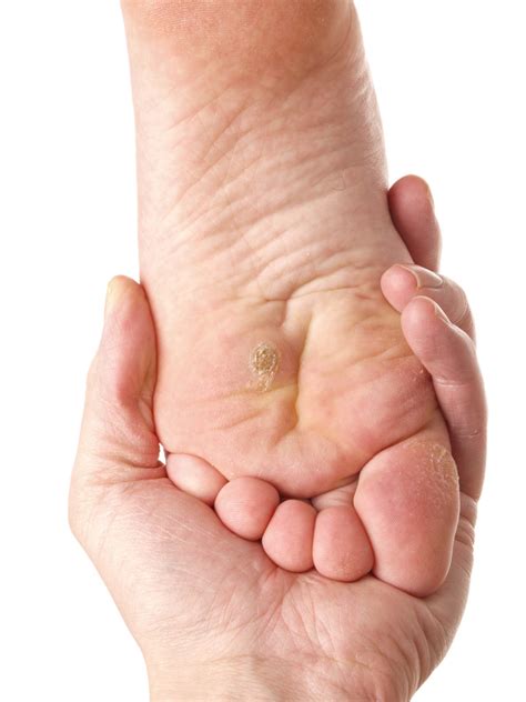 Plantar Warts Verruca Perth Foot Centre Plantar Warts Verruca Perth Foot Centre