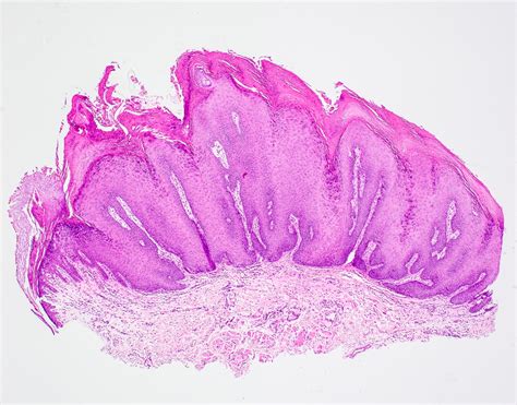 Verruca Vulgaris Libre Pathology Verruca Vulgaris Libre Pathology
